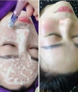 CẤY TRẮNG TĂNG SINH COLLAGEN