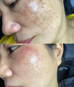 ĐIỀU TRỊ TÀN NHANG