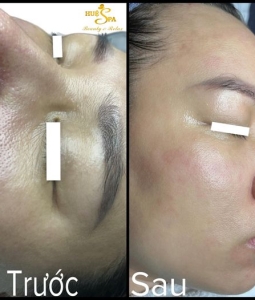 TRẺ HÓA CĂNG BÓNG DA