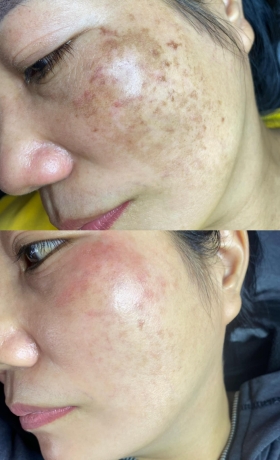 ĐIỀU TRỊ TÀN NHANG