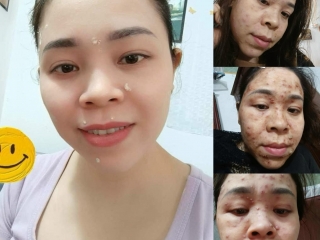 ĐIỀU TRỊ SẸO RỖ, THỦY ĐẬU