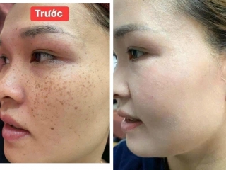 ĐIỀU TRỊ TÀN NHANG CHÂN ĐINH