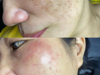 ĐIỀU TRỊ TÀN NHANG CHÂN SÂU