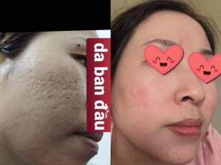 ĐIỀU TRỊ SẸO RỖ, ĐÁY NHỌN