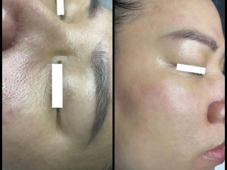 TRẺ HÓA CĂNG BÓNG DA